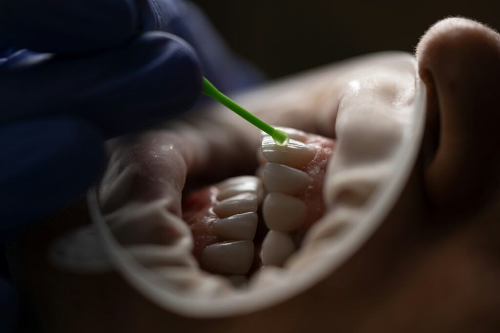cavities between teeth